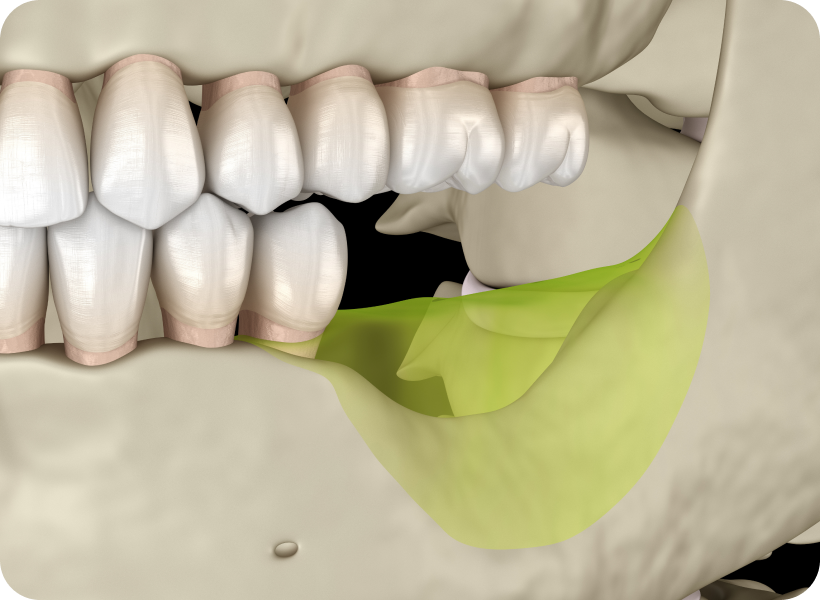 comblement osseux chevreuse Comblement osseux Cabinet Dental Vallée | Dentistes Chevreuse