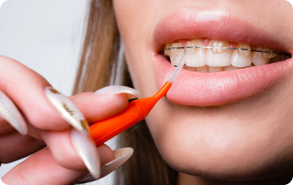 brossage appareils dentaires chevreuse brossage appareils dentaires chevreuse Appareils dentaires Cabinet Dental Vallée | Dentistes Chevreuse