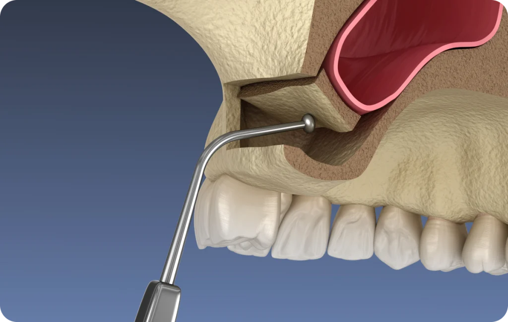 comblement osseux chevreuse comblement osseux chevreuse Comblement osseux Cabinet Dental Vallée | Dentistes Chevreuse