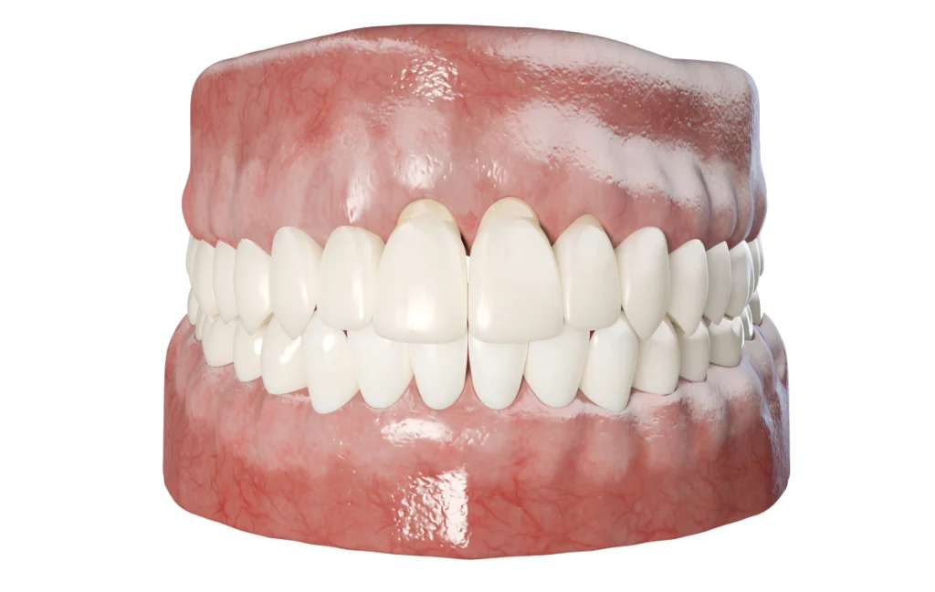 dechaussement dents chevreuse prevention parodontale Déchaussement des dents Cabinet Dental Vallée | Dentistes Chevreuse