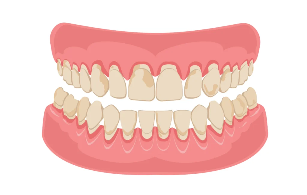 dechaussement dents chevreuse soins cibles Déchaussement des dents Cabinet Dental Vallée | Dentistes Chevreuse