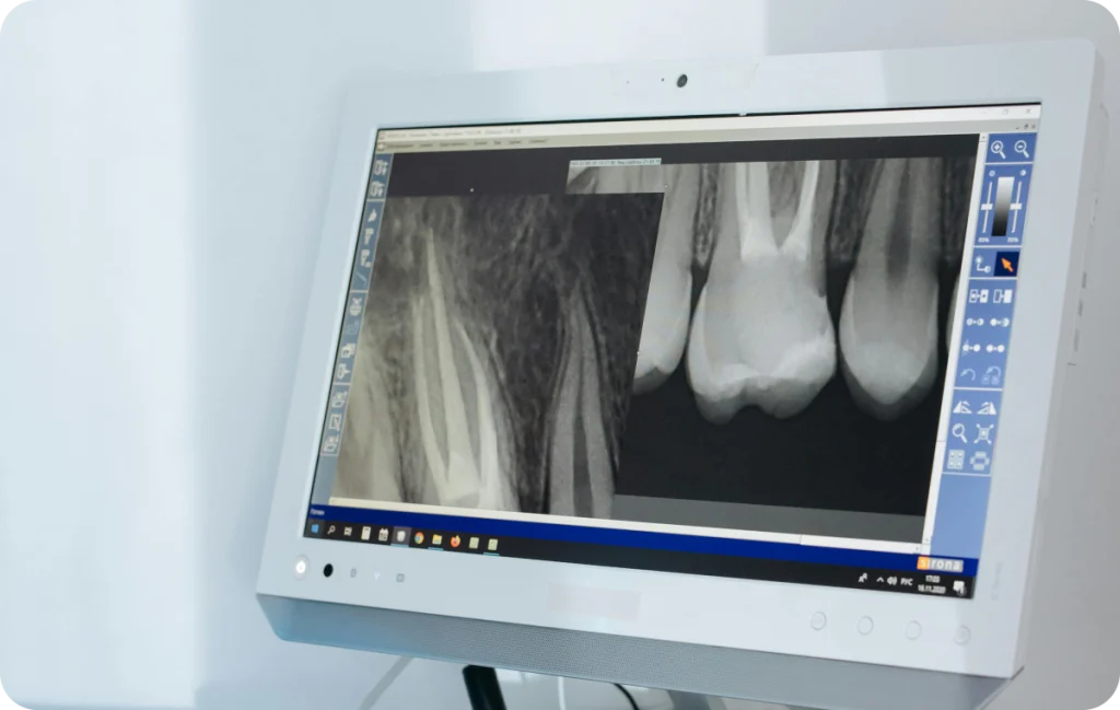 endodontie chevreuse dentiste Traitement et retraitement de racine Cabinet Dental Vallée | Dentistes Chevreuse