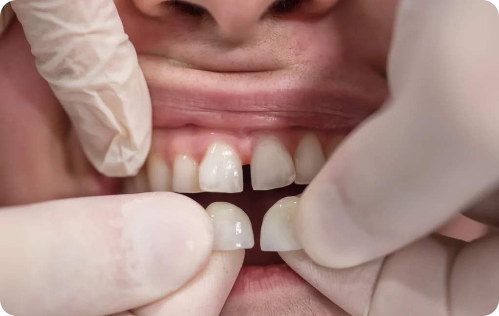 facettes chevreuse esthetique dentaire Facettes Cabinet Dental Vallée | Dentistes Chevreuse