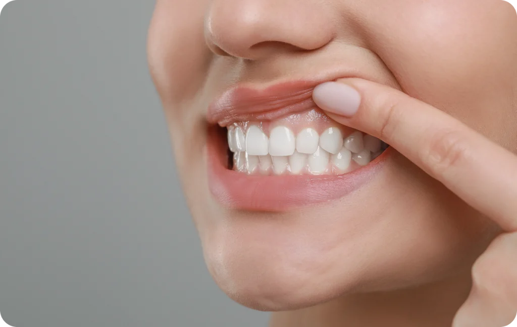 greffe gencive parodontologie chevreuse Greffe des gencives Cabinet Dental Vallée | Dentistes Chevreuse